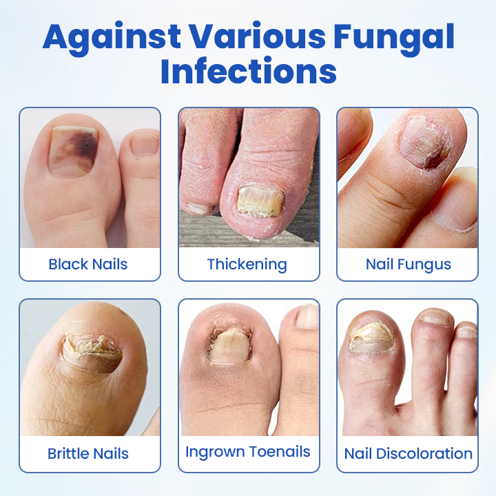 Timilk® FungalPatch - Antibacterial Fungal Patch