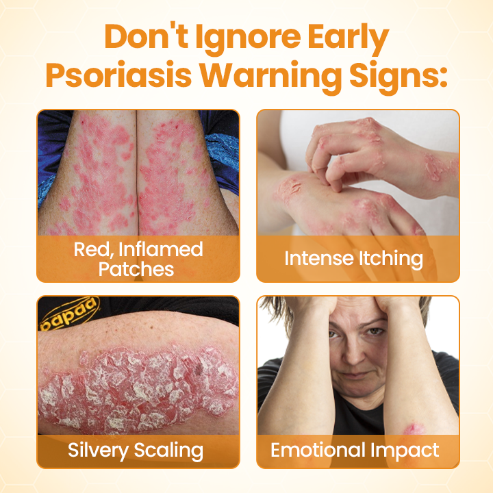 Timilk® BeeLieve Psoriasis Skin Care