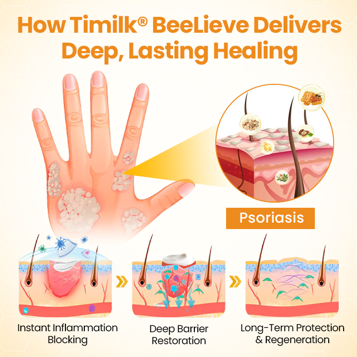 Timilk® BeeLieve Psoriasis Skin Care