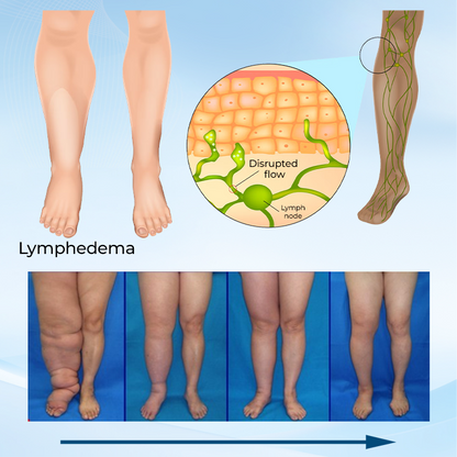 ✅ Official Store: Timilk® LymphoEase Magnesium PCA Roll-On Relief Cream 🔥 FDA Certified (Clinically Proven Relief for Lymphedema, Leg Swelling & Poor Circulation 🩺)