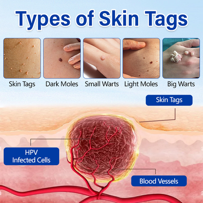 Timilk® WartClear Herbal Ointment